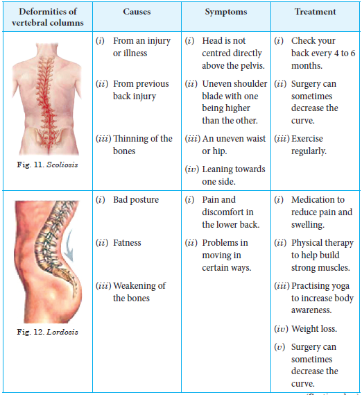 Deformities of Vertebral Column or Spine